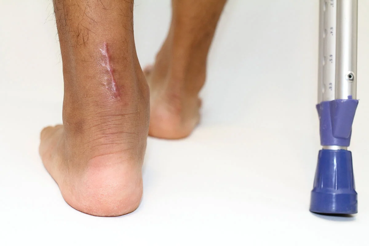 Hero image for article "Patient Factors in Achilles Rupture Treatment"