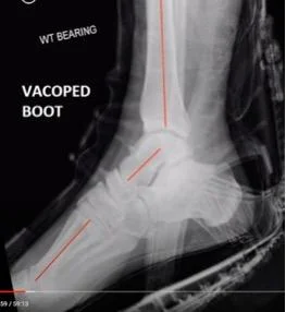 X-ray showing VACOped ankle positioning