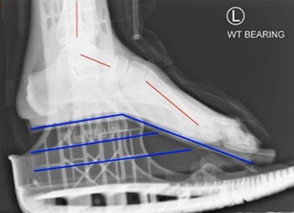 X-ray showing Aircast with wedges ankle positioning